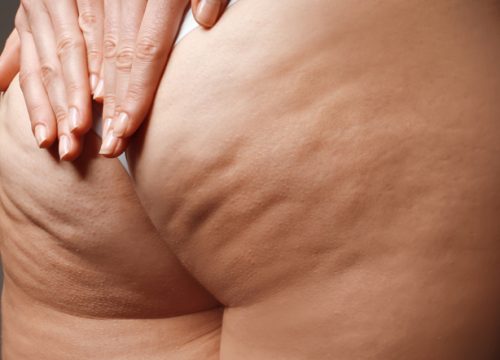 Woman's cellulite before Cellfina treatments