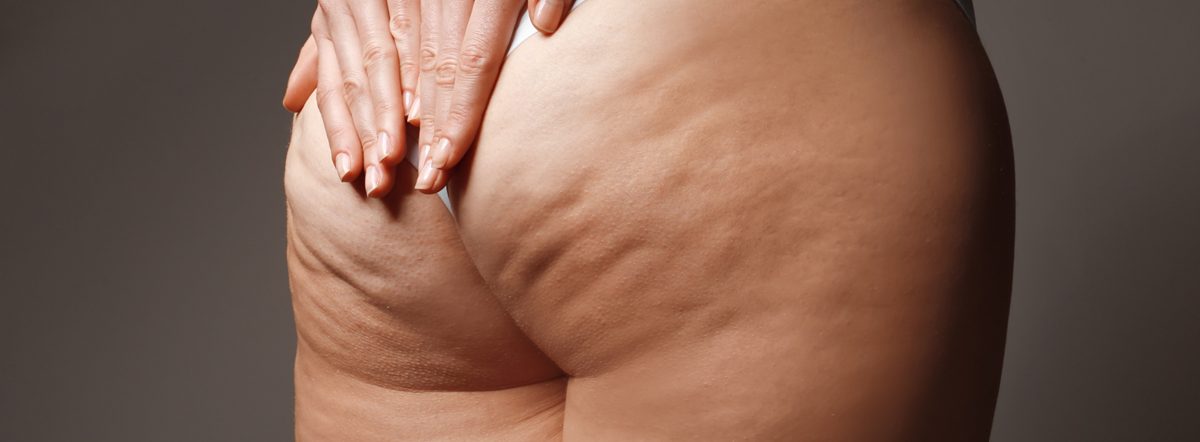 Cellfina® - Cellulite Treatment