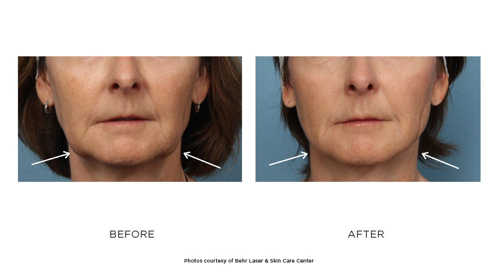 Before and after Kybella results
