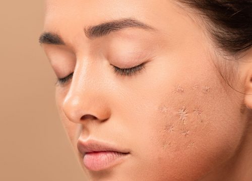 Young woman with acne and acne scarring