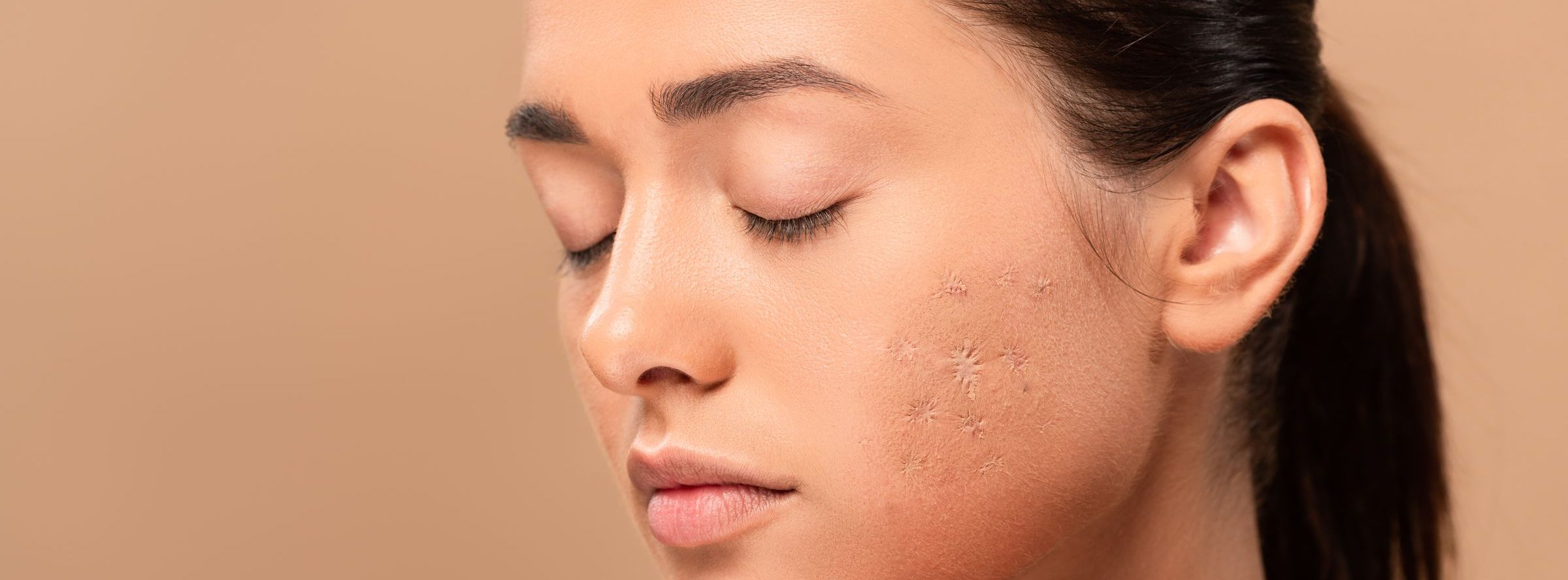 Acne and Acne Scarring