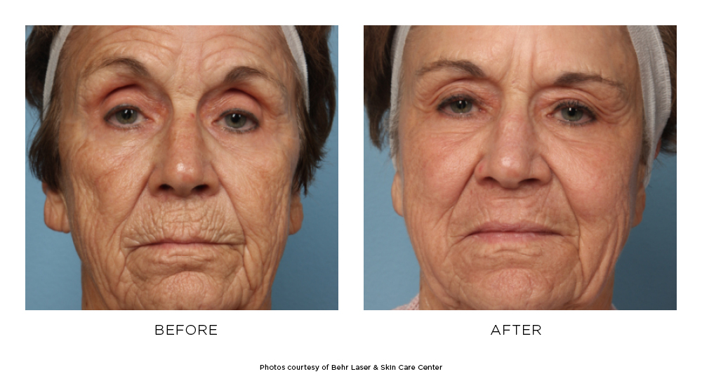 Before and after Active FX™ results