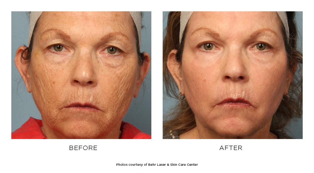Before and after Active FX™ results