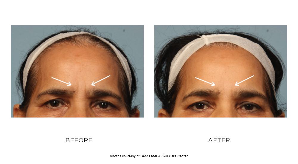 Before and after BOTOX® results