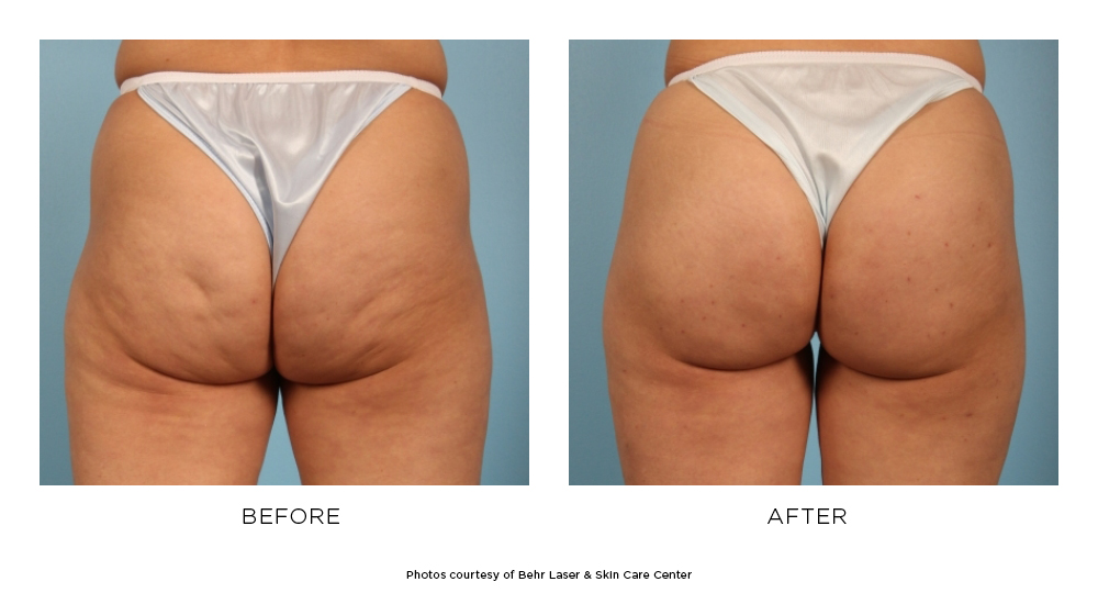 Before and after Cellfina® results