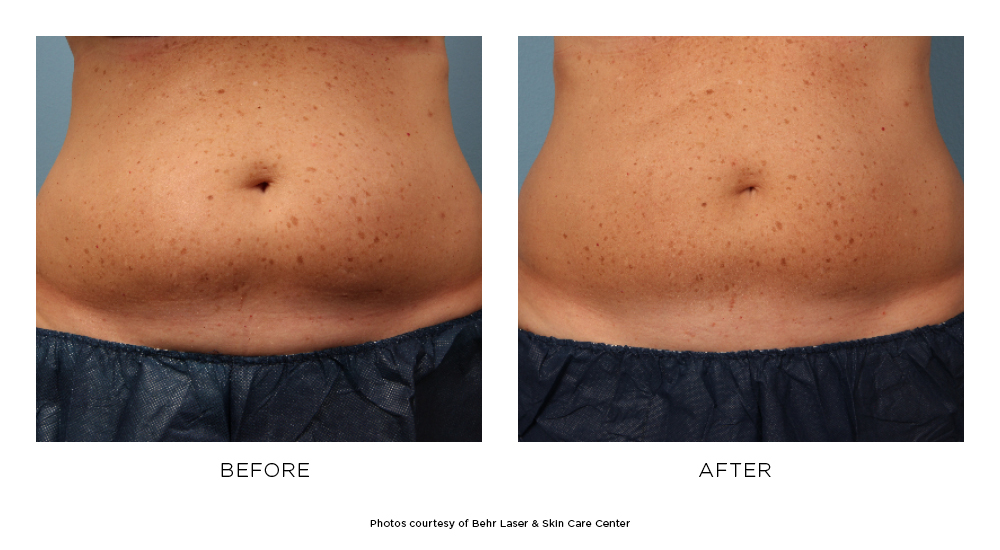 CoolSculpting® Elite Before & After Photos | Behr Laser & Skin Care Center