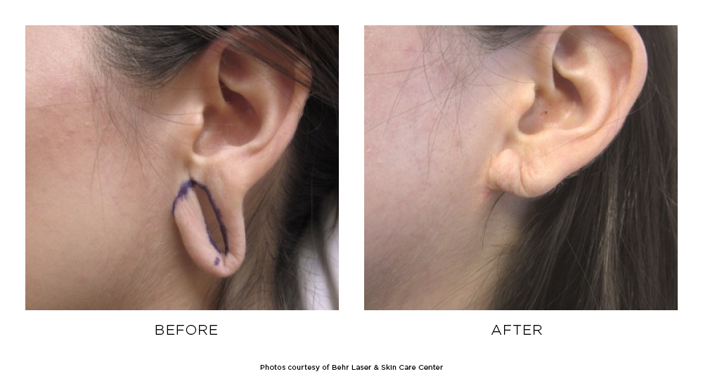 Before and after ear lobe repair results