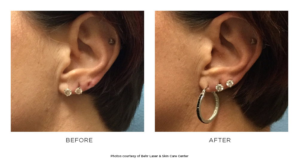 Before and after ear lobe repair results