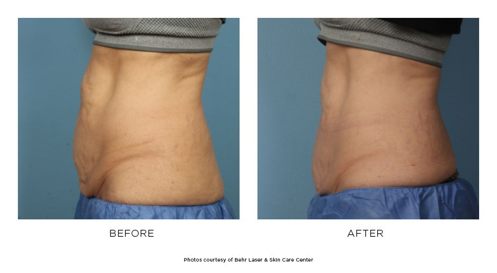 Before and after Emsculpt® results