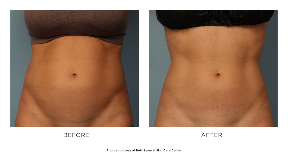 Before and after Emsculpt® results