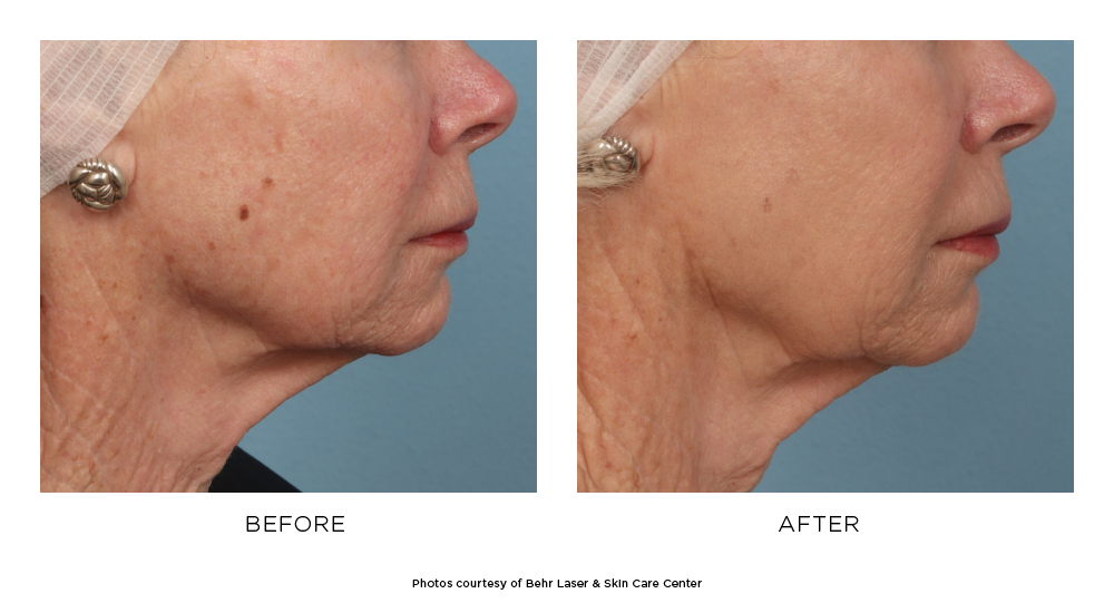 Before and after Fraxel® results