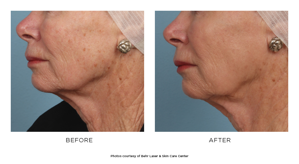 Before and after Fraxel® results