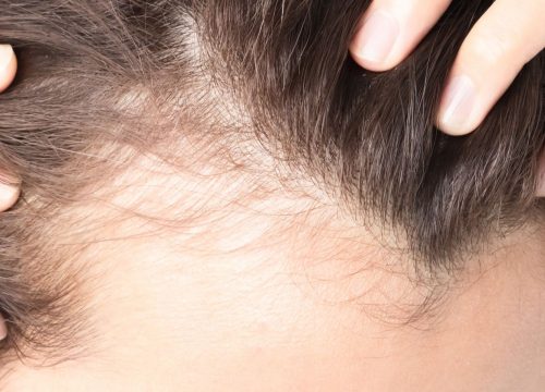Hair loss in a woman's scalp