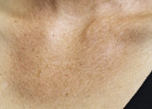 Hyperpigmentation on chest