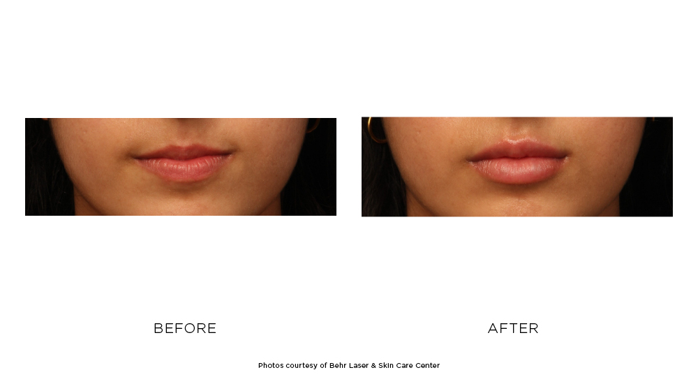 Before and after filler results