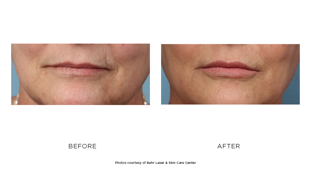 Before and after filler results
