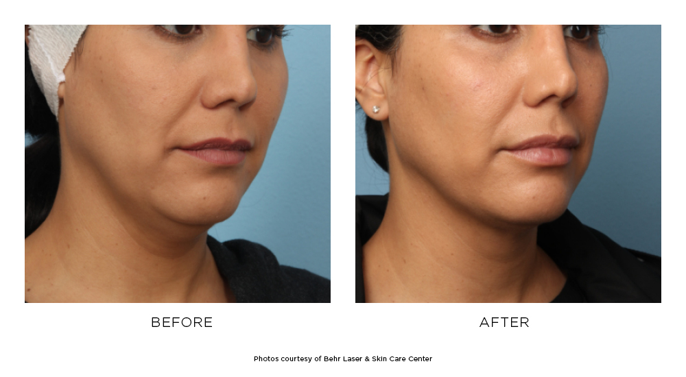 Kybella® Before And After Photos Behr Laser And Skin Care Center