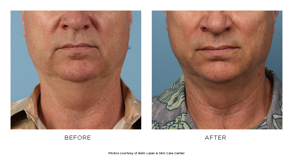 Before and after KYBELLA® results