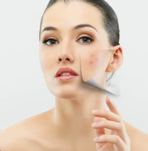 Woman with acne