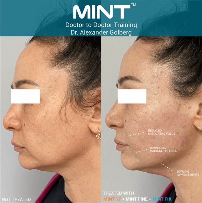 MINT™ PDO NonSurgical Threads Behr Laser & Skin Care Center