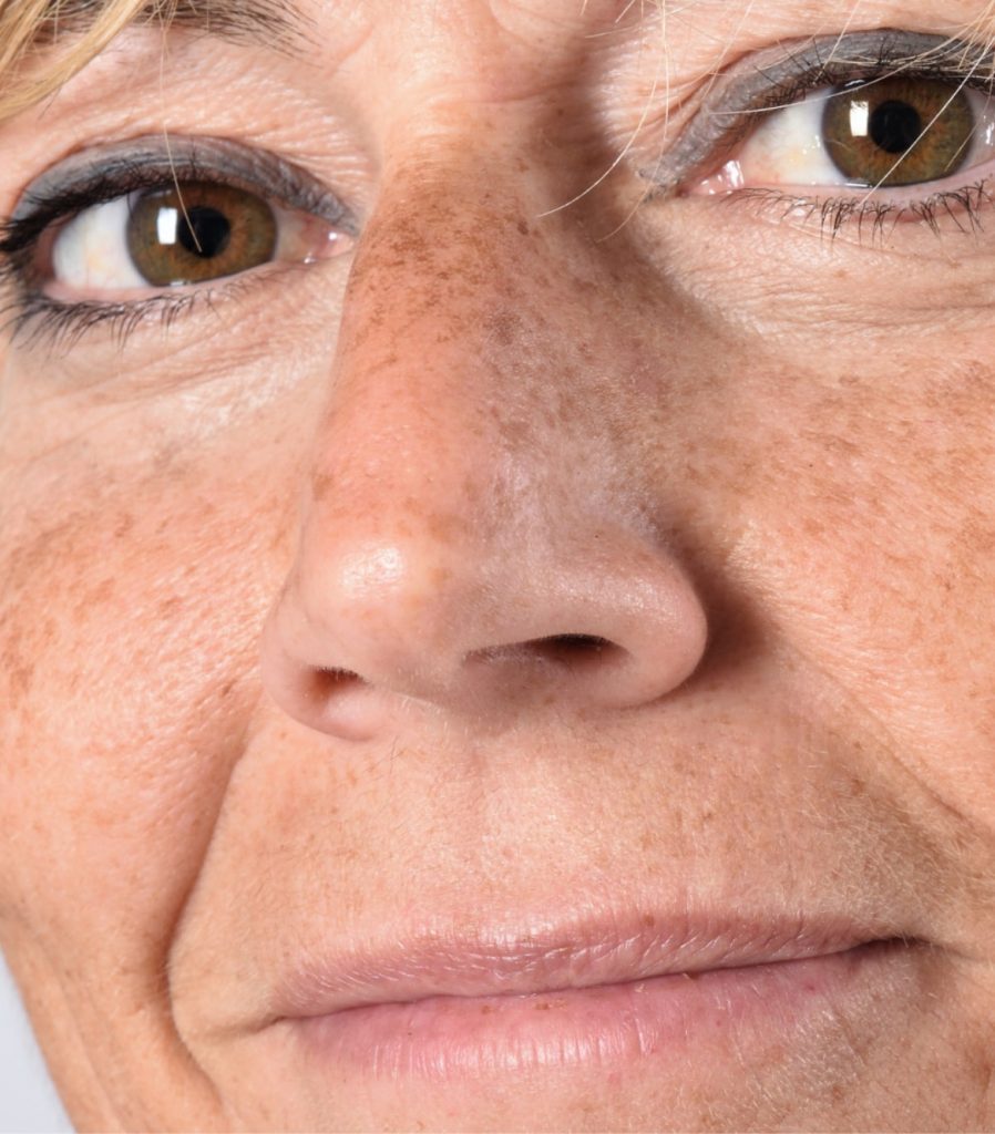 Woman with age spots