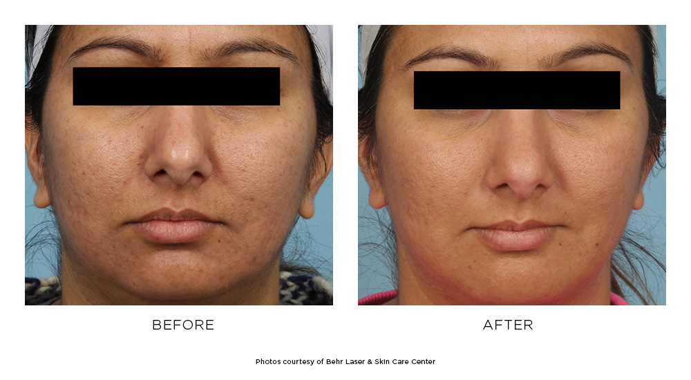Before and after Microneedling results