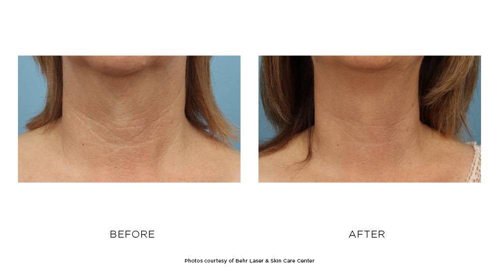 Before and after Nectifirm results