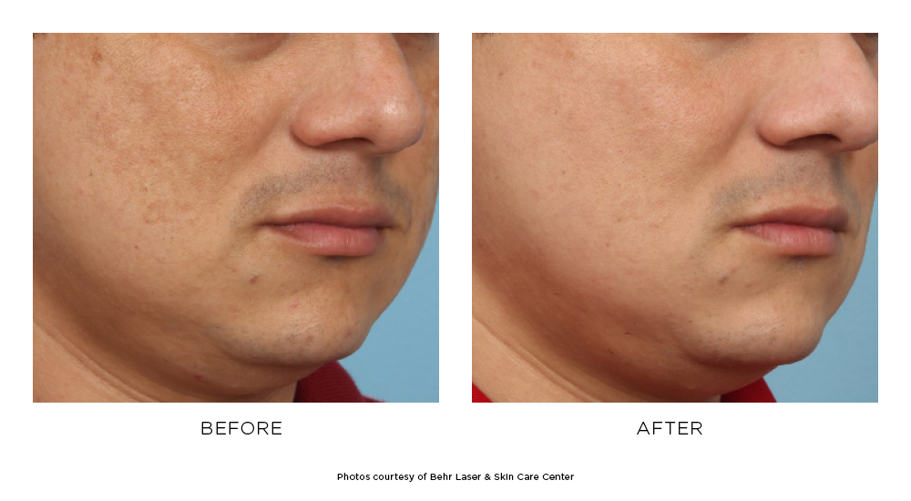 Before and after Clear + Brilliant Perméa® results