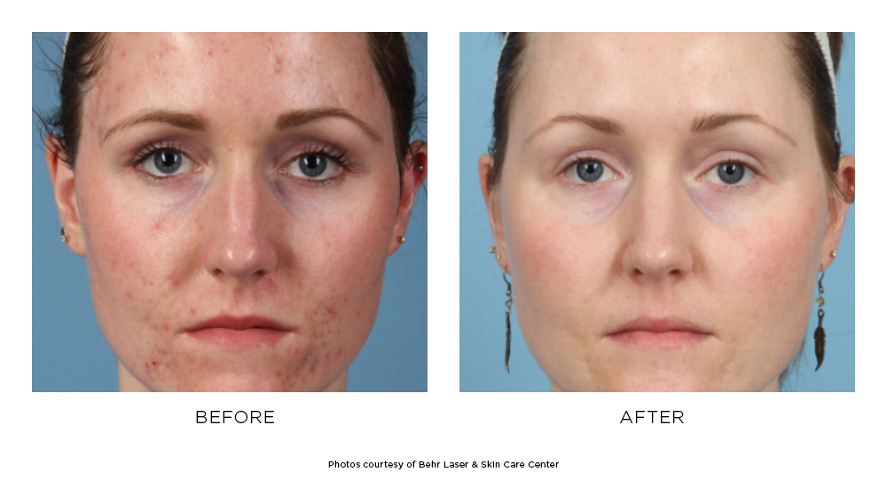 Before and after PicoSure® results