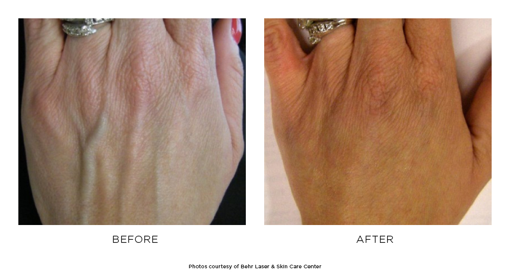 Before and after Radiesse results on the hand