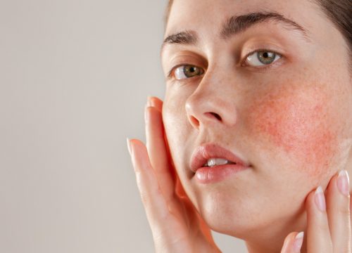 Woman with rosacea on her face