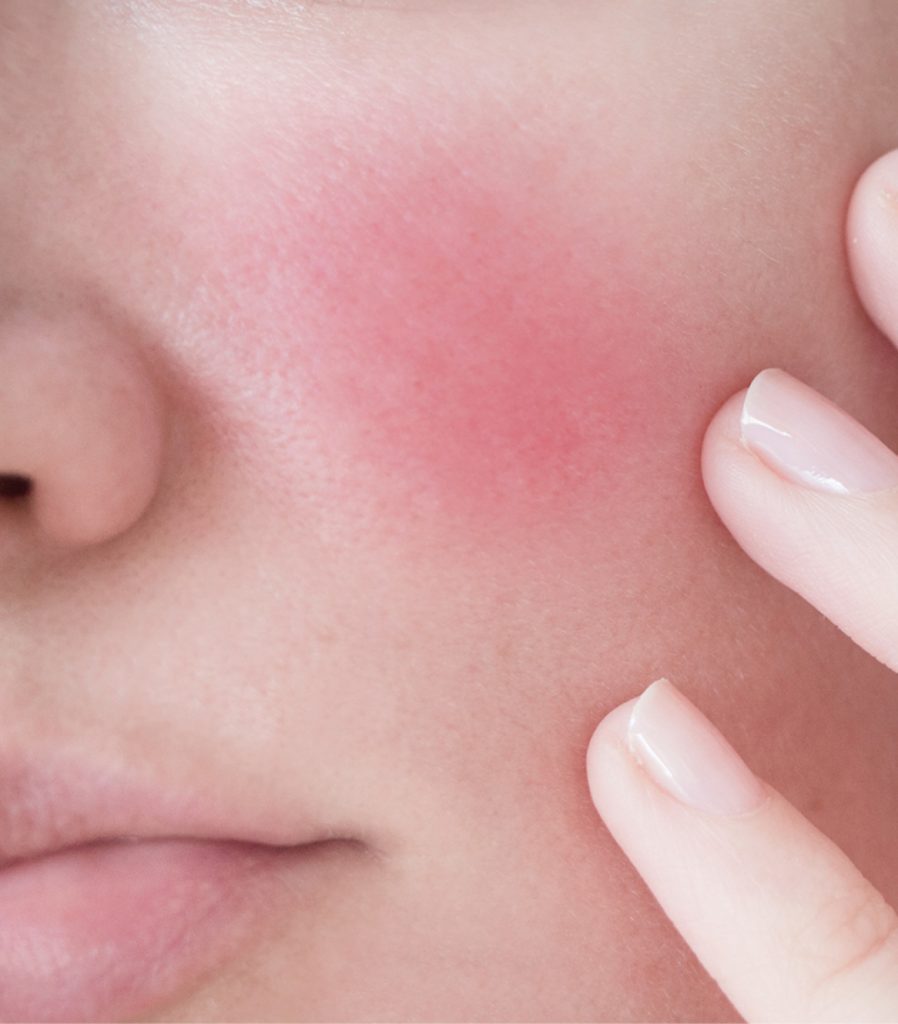 Closeup of rosacea on cheek