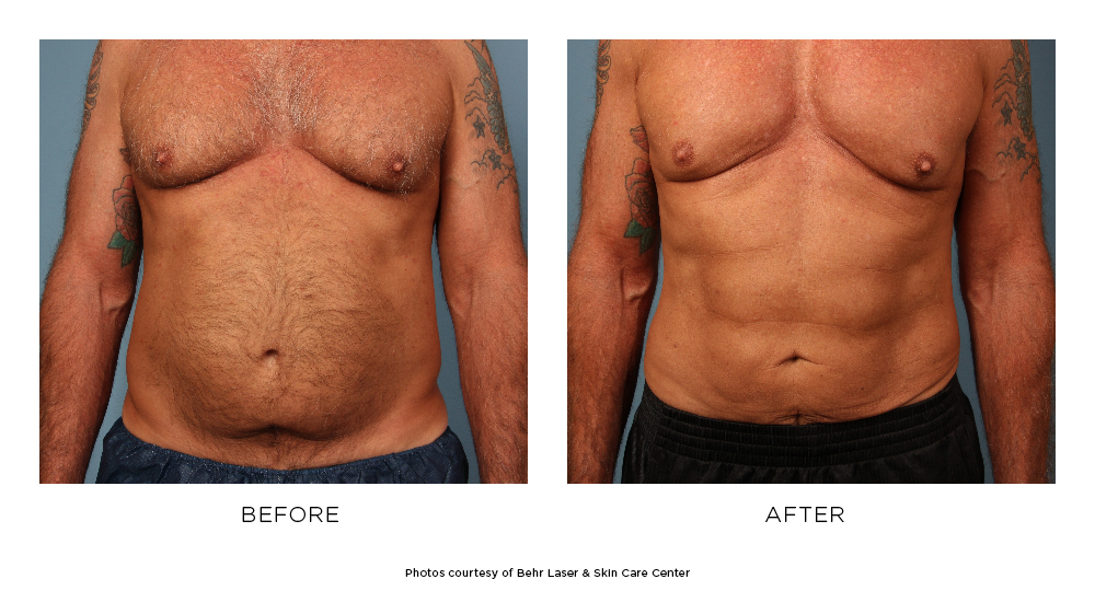 Before and after SmartLipo results
