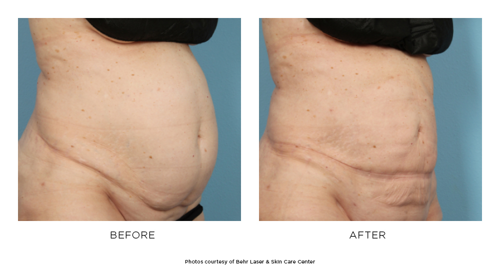 Before and after SmartLipo results