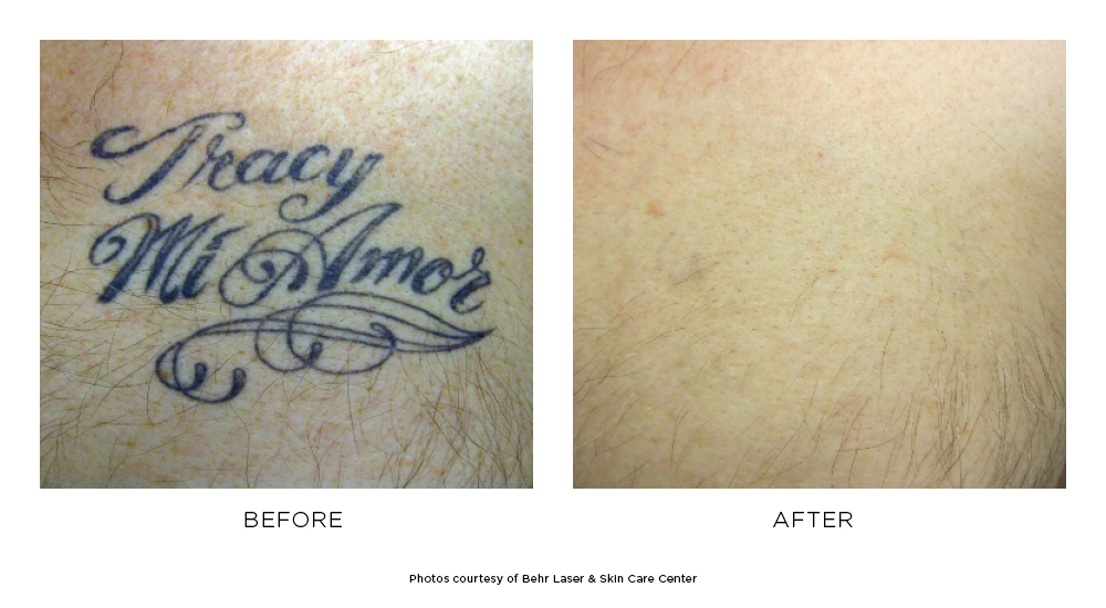 Before and after Tattoo Removal results