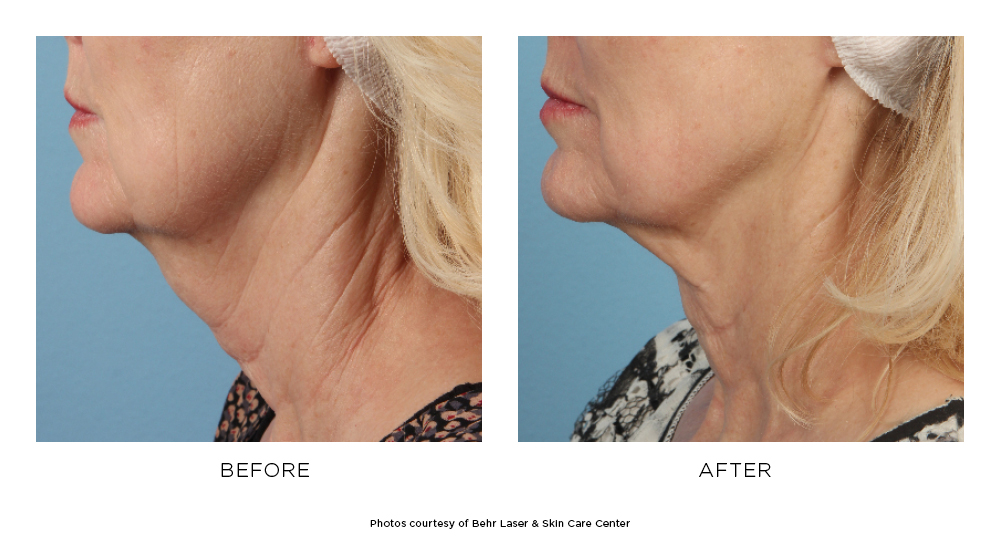 Before and after ThermiTight results