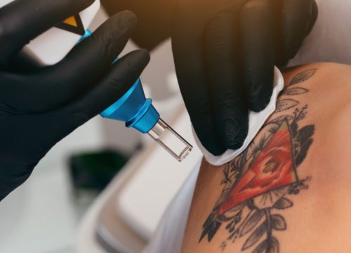 Unwanted tattoo removal on arm
