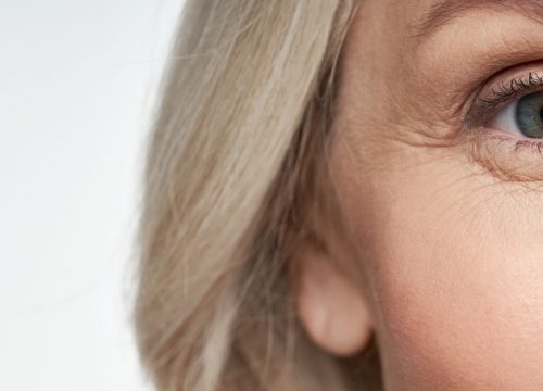 Wrinkles around a woman's eye