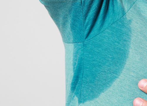 Armpit sweat before Miradry treatments