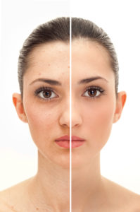 Before and after laser skin resurfacing