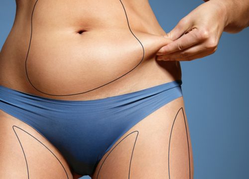 Woman pulling on her stomach fat before Smartlipo Triplex