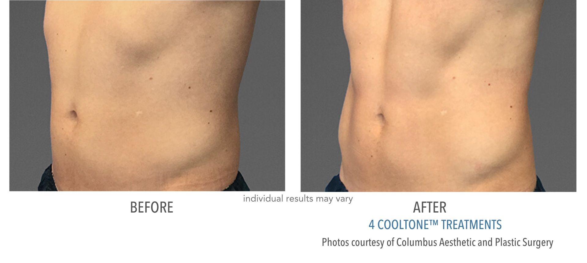 Before and after CoolTone™ results
