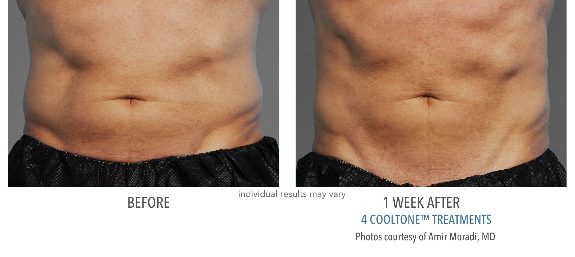 Before and after CoolTone™ results