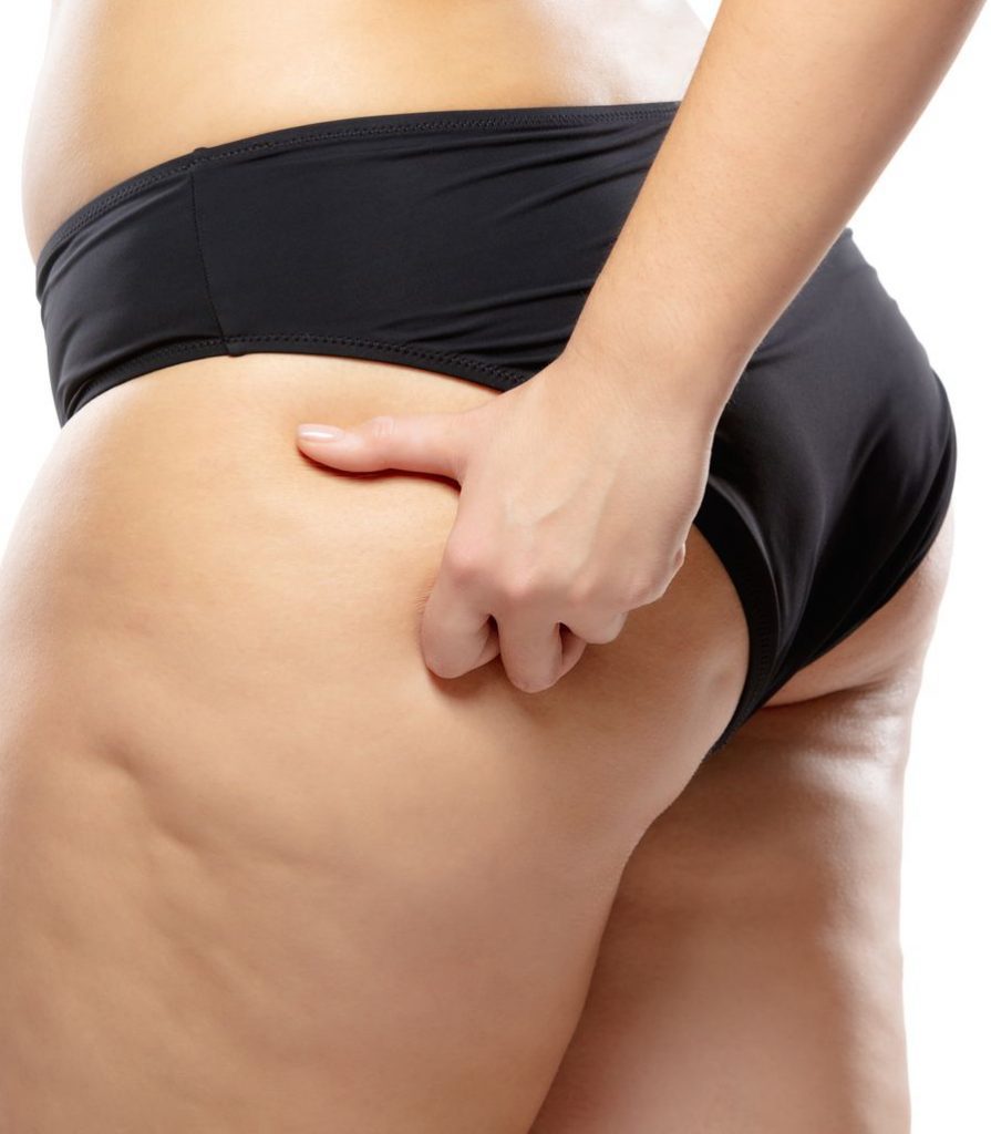 Cellulite on a woman's body