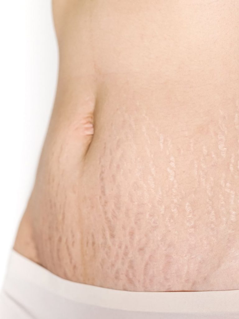 Stretch marks on a person's body