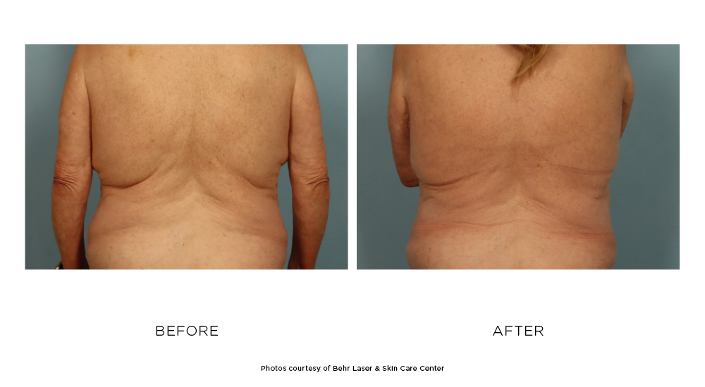 Before and after CoolSculpting Elite Flank treatments