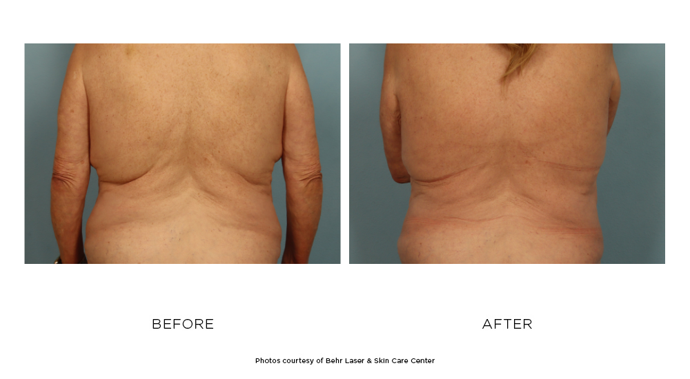 CoolSculpting Elite Before and After  New Treatment + Better Results —  Emerson Medical