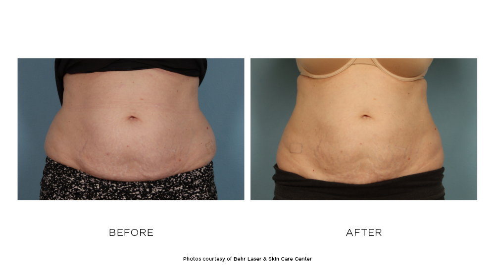 CoolSculpting Elite, reducing fat on tummy & flanks, before and after