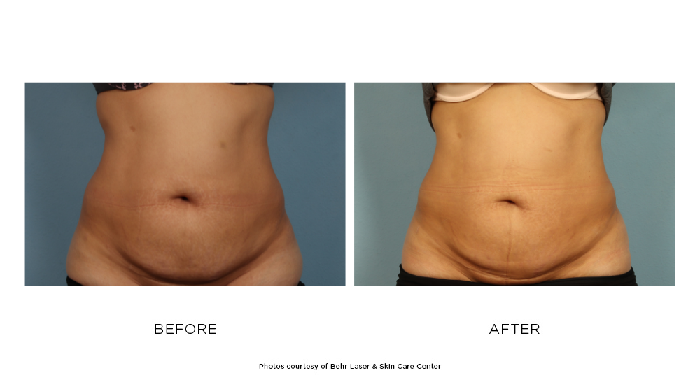 Before and after CoolSculpting Elite results