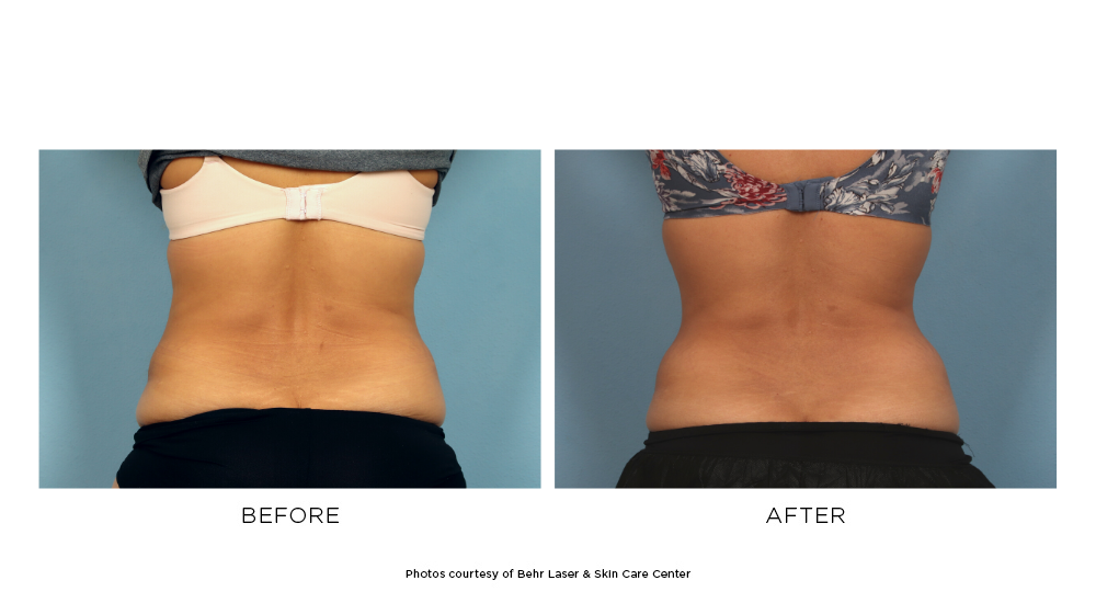 Before and after CoolSculpting Elite Flank treatments
